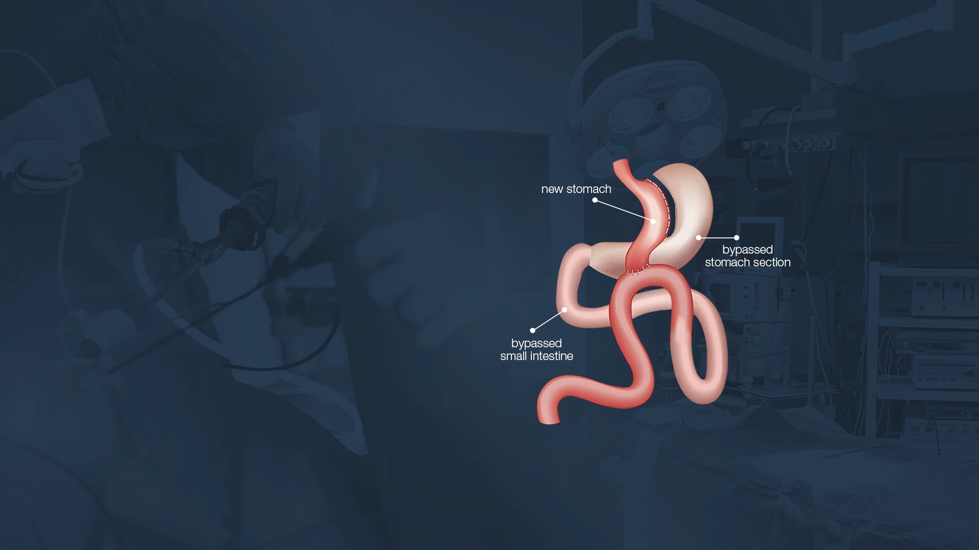 Diabetes Surgery (Metabolic Surgery)