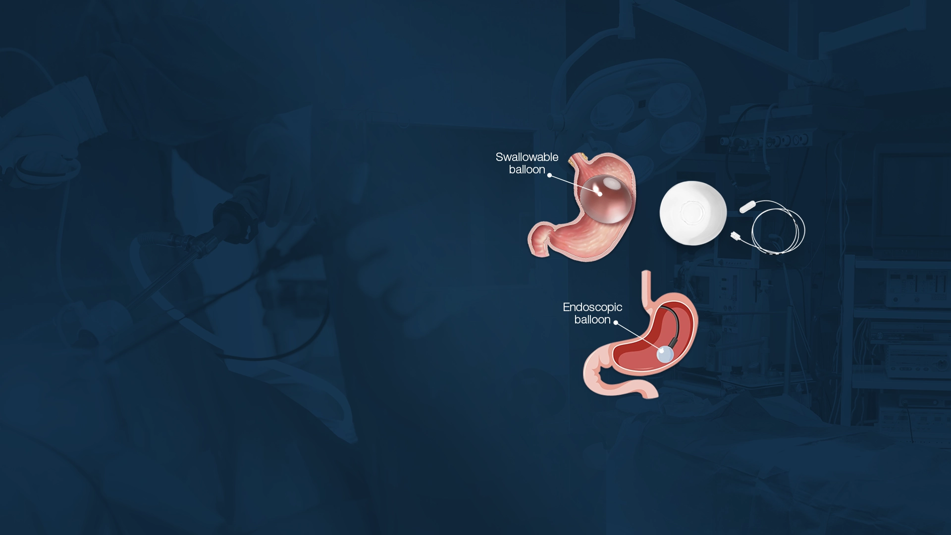 Gastric Balloon Options