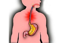 GASTRO ÖZOFAJİAL REFLÜ HASTALIĞI VE TEDAVİSİ